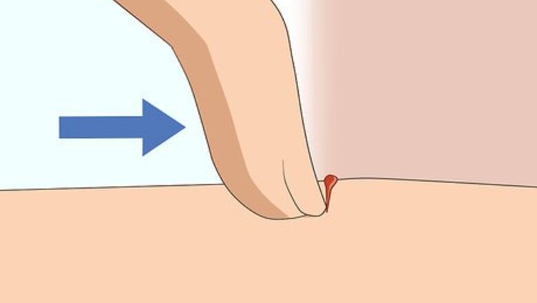 How to Soothe Bug Bites