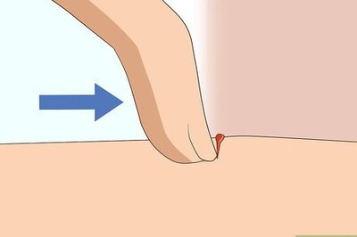 How to Soothe Bug Bites