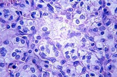 Condoms can work against cancer