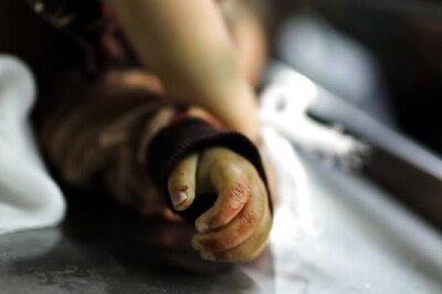 Nurse Injures Baby's Thumb While Cutting Bandage in Ahmedabad, Case Filed