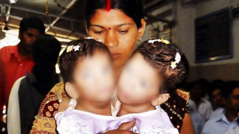 Conjoined twins separated after 12-hr surgery