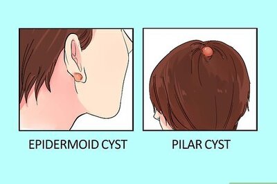 How to Treat a Cyst: Pain Relief and Home Remedies