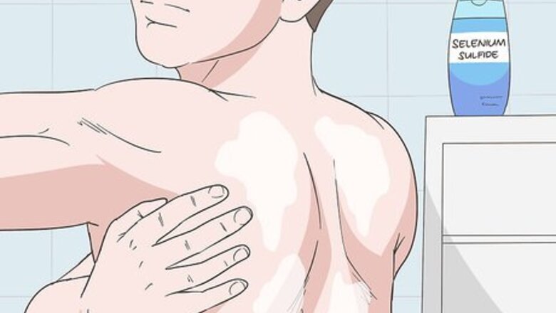 How to Treat Fungal Acne on Your Back