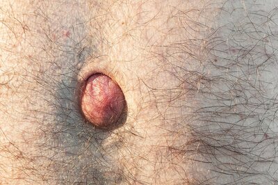 Risk of Hernia Is Greater In Obese Patients: Should You Undergo Weight Loss Surgery To Prevent This Health Problem?