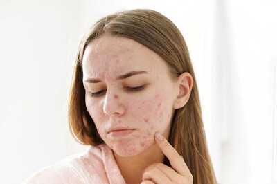 Research Finds How Fat Cells In Skin Help Fight Acne