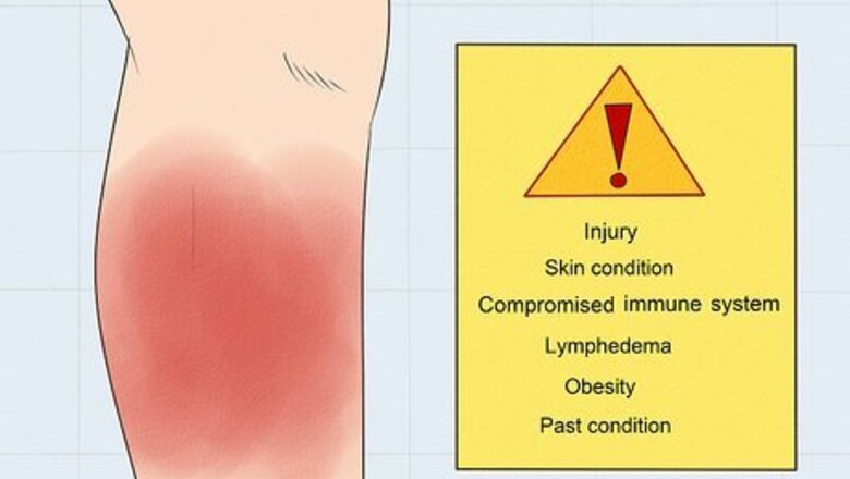 How to Treat Cellulitis