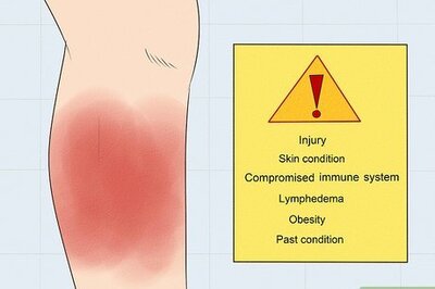 How to Treat Cellulitis