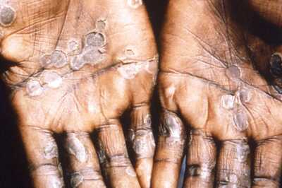98% Monkeypox Patients Gay or Bisexual Men: New England Journal of Medicine Study