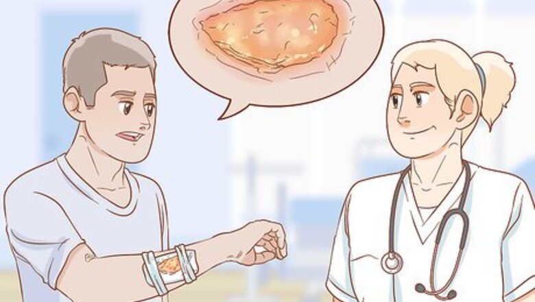 How to Treat an Infected Burn