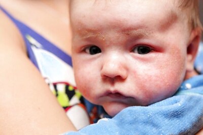 Antibiotics Aren't An Effective Treatment For Milder Forms of Eczema