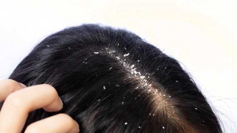 A Guide to Choosing The Right Ingredients In A Shampoo To Tackle Dandruff