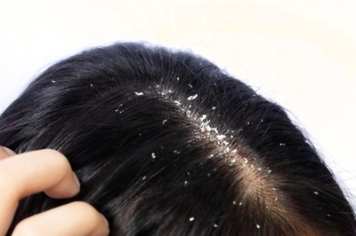 A Guide to Choosing The Right Ingredients In A Shampoo To Tackle Dandruff