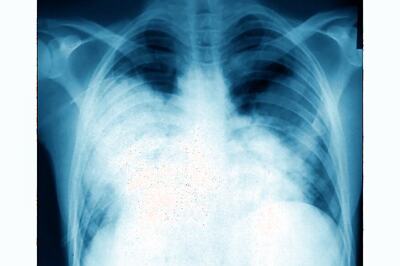 Stanford Researchers Develop Algorithm That Detects Pneumonia Better Than Radiologists