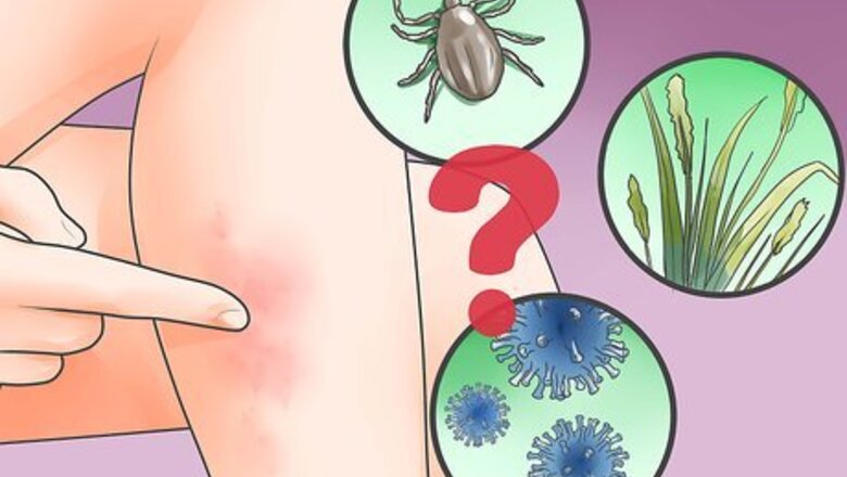 How to Treat a Skin Infection
