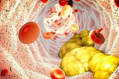 Ghee To Red Meat, 5 Foods You Must Avoid To Keep Cholesterol In Check