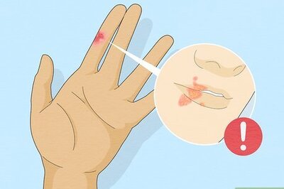 How to Diagnose and Treat Whitlow Symptoms