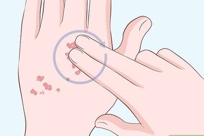 How to Heal Scabies Scars