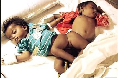 West Bengal: Conjoined twins separated by rare surgery at Burdwan government hospital