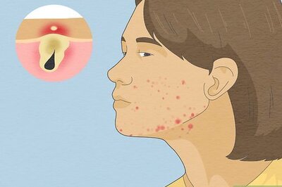 Hormonal VS Bacterial Acne: What’s the Difference and How Do You Treat Them?