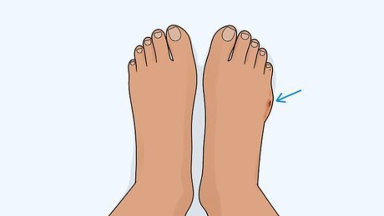 How to Heal a Toe Injury