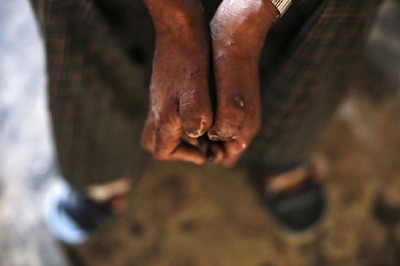 Lok Sabha Passes Bill to Remove Leprosy as Ground for Divorce