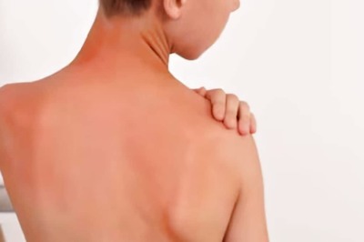 10-year-old UK Boy Undergoes Surgery After Suffering From Sunburn