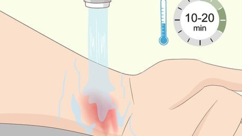 How to Treat Treadmill Burns