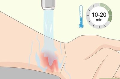 How to Treat Treadmill Burns