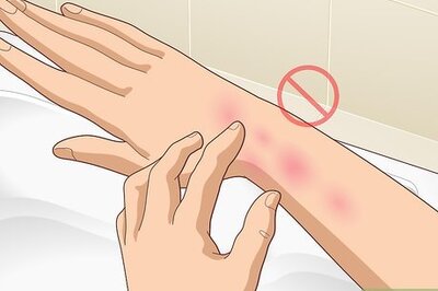 How to Get Rid of Poison Oak Rash