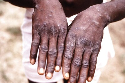 There's a New Disease in Town: Monkeypox. Cases in Europe & US are 'Puzzling Experts', Does India Need to Worry? News18 Explains