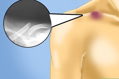 How to Treat a Clavicle Fracture