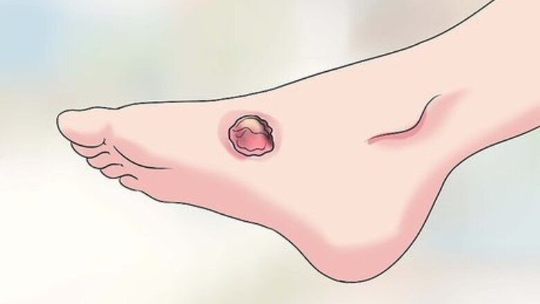 How to Cure Jungle Rot
