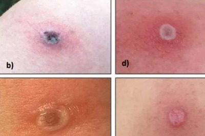 Alaskapox Claims Its First Victim: Elderly Man from US' Alaska Succumbs to Deadly Virus