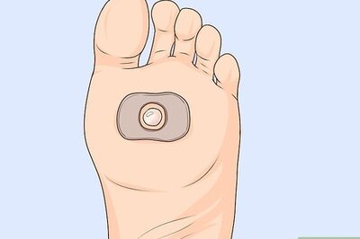 How to Heal Blisters Fast