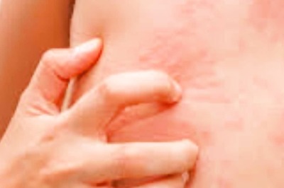 Easy Ways To Prevent Skin Allergies In Summers