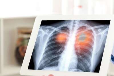 Non-Smokers' Lung Cancers Caused By Tumors Arising From Genetic Mutations, Says Study