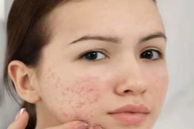 7 Tips To Keep Your Skin Acne Free