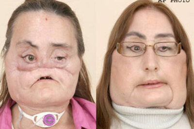First face transplant patient in US shows face