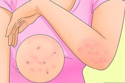 How to Cure Scabies