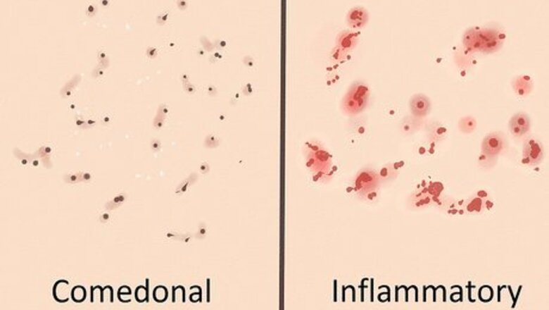 How to Get Rid of Acne if You Have Fair Skin