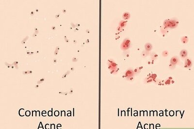 How to Get Rid of Acne if You Have Fair Skin