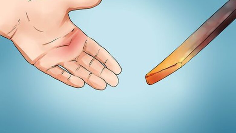 How to Treat Second Degree Burns Caused by Heat