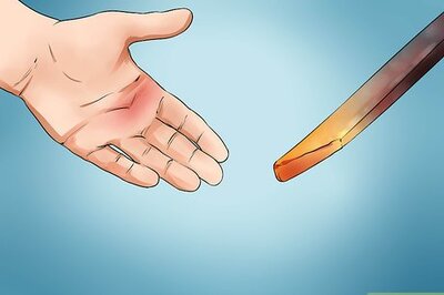 How to Treat Second Degree Burns Caused by Heat