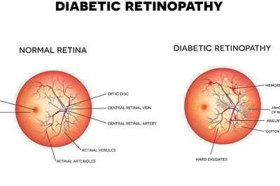 Managing Diabetic Retinopathy In India - A Not So Sweet Pill