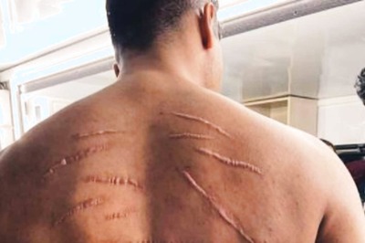 Vicky Kaushal Shares Picture of His Injured Back from 'Sardar Udham', Fans Shower the Post with Love