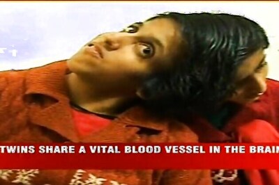 17-year-old cojoined twins Farah, Saba admitted to hospital twice in 5 days, critical